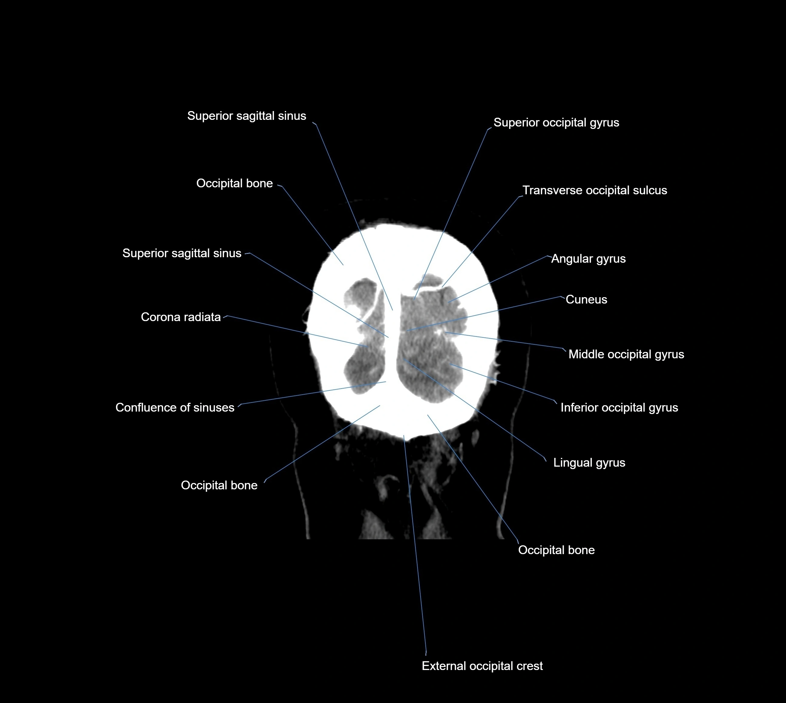 CT Brain coronal cross sectional radiology anatomy image  -img-00001-043.webp